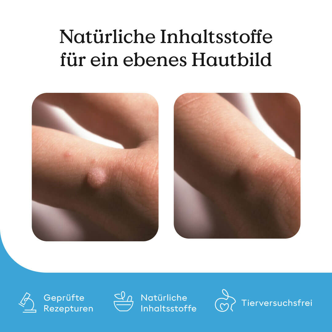 Wart Care Pen