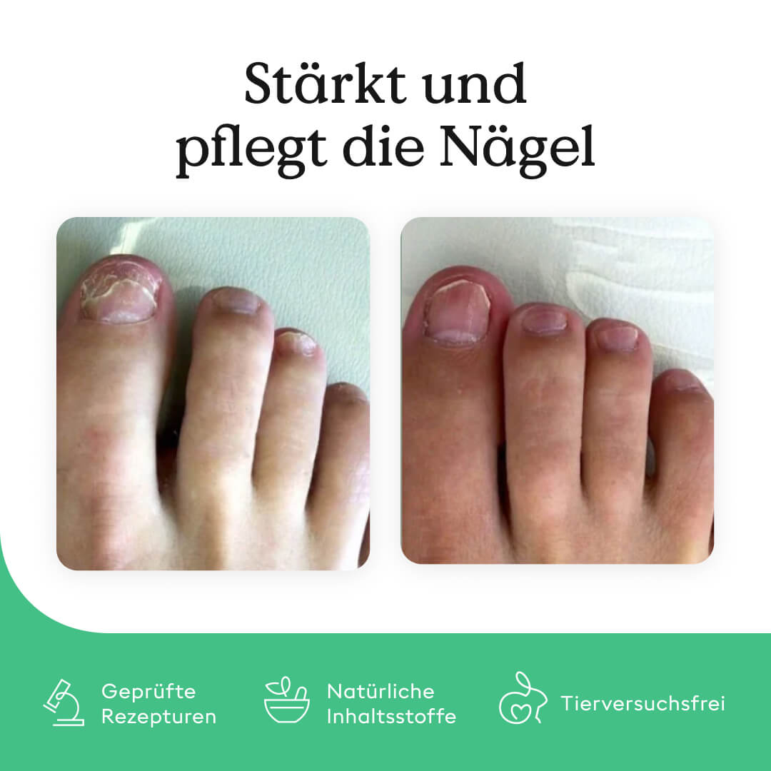 Maxi-Set „Nagelpilz-Kur“